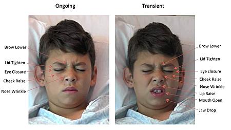 Anthropometric software detects facial attributes of pain